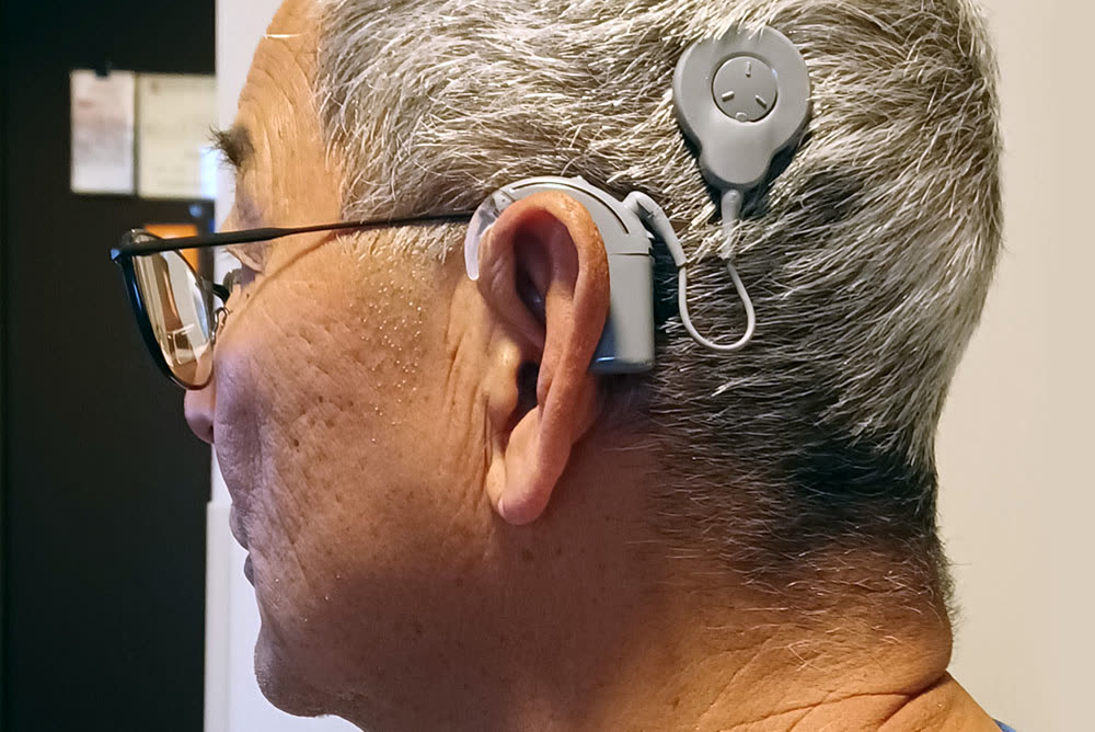 Patient wearing a behind-the-ear cochlear implant sound processor with magnetic headpiece